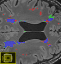 BA WMH Segmentation BA WMH Segmentation